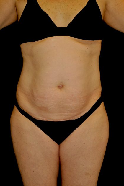 Tummy Tuck Before & After Patient #15125