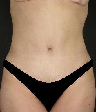 Lipoabdominoplasty Before & After Patient #15174