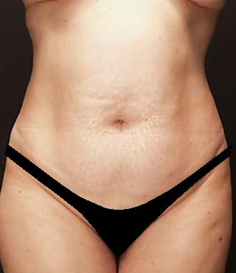 Lipoabdominoplasty Before & After Patient #15174