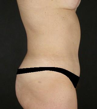 Lipoabdominoplasty Before & After Patient #15174