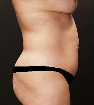Lipoabdominoplasty Before & After Patient #15174