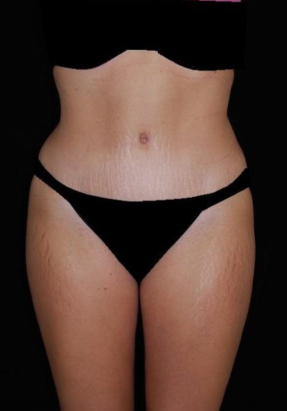Tummy Tuck Before & After Patient #15181