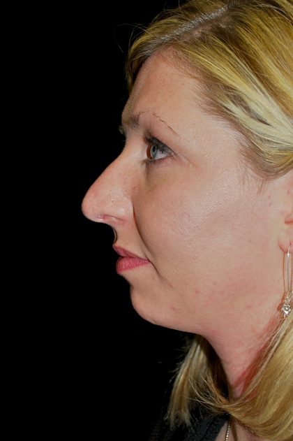 Chin Implants (Augmentation) Before & After Patient #14798