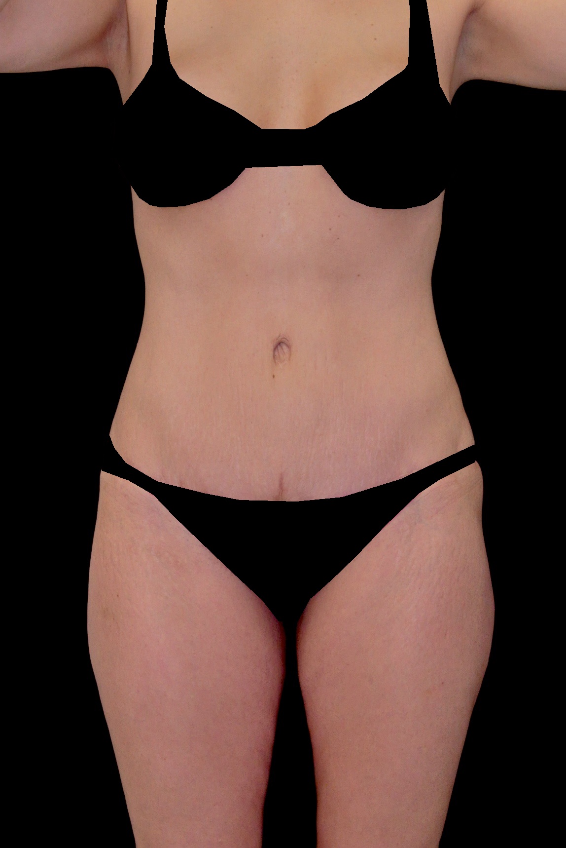 Tummy Tuck Before & After Patient #14938
