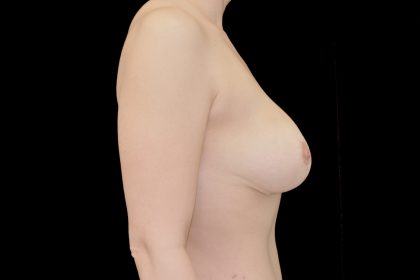 Breast Revision Before & After Patient #14685