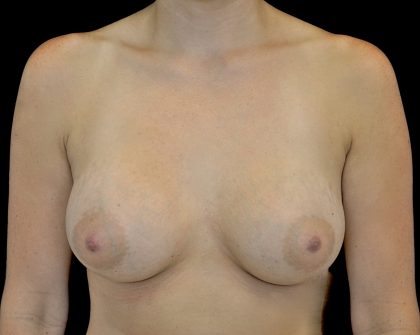 Breast Augmentation (Implants) Before & After Patient #14198
