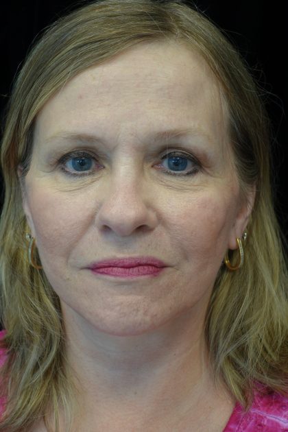 Facelift Before & After Patient #14832