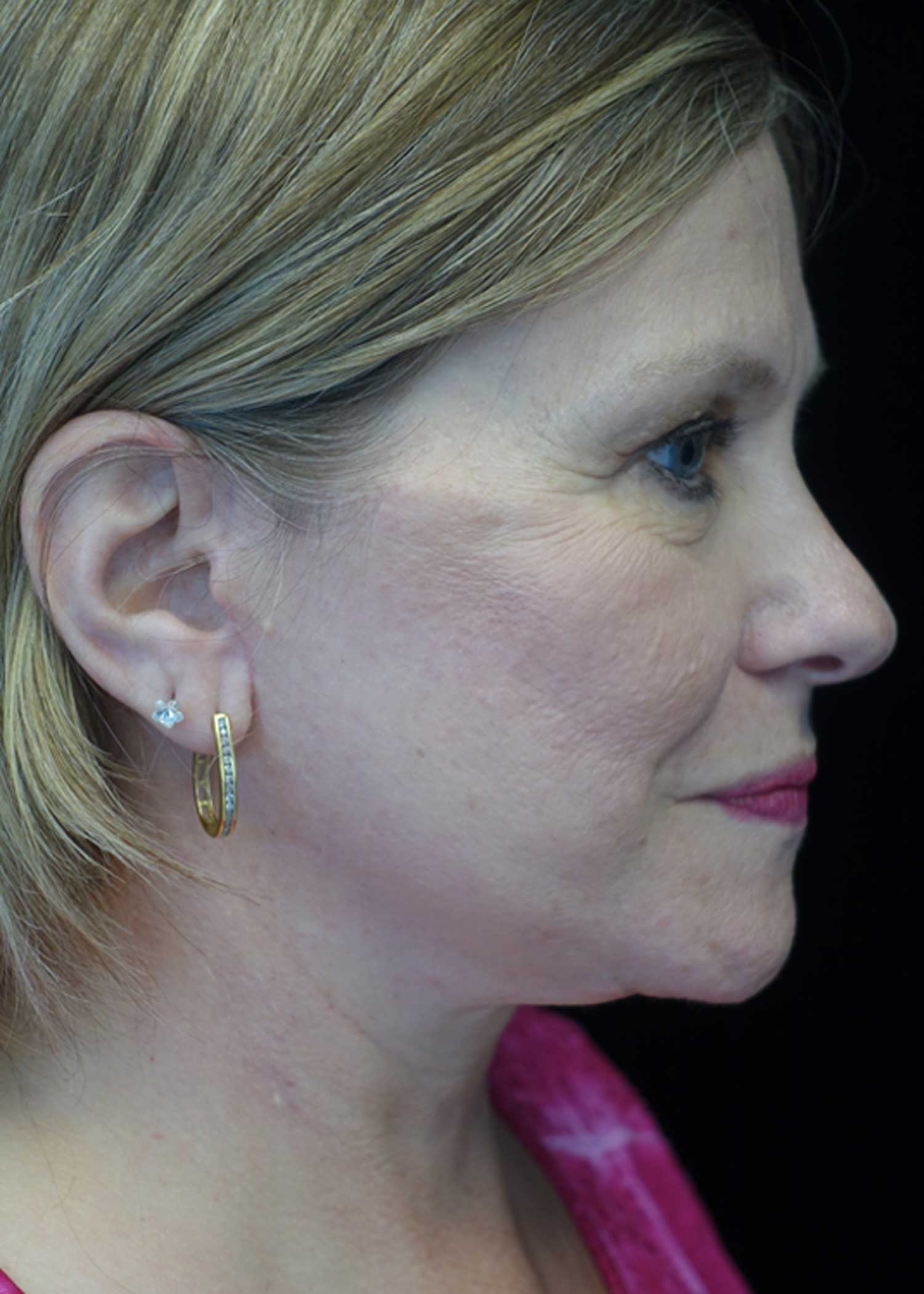 Facelift Before & After Patient #14832