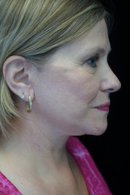 Facelift Before & After Patient #14832