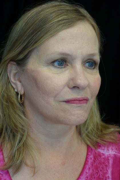 Facelift Before & After Patient #14832