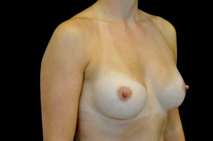 Breast Augmentation (Implants) Before & After Patient #14149