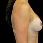 Breast Augmentation (Implants) Before & After Patient #14149