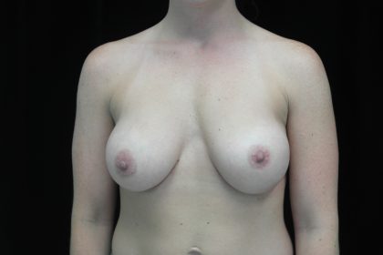 Breast Augmentation (Implants) Before & After Patient #14332