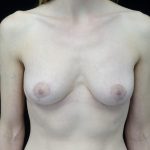 Breast Lift Before & After Patient #14396