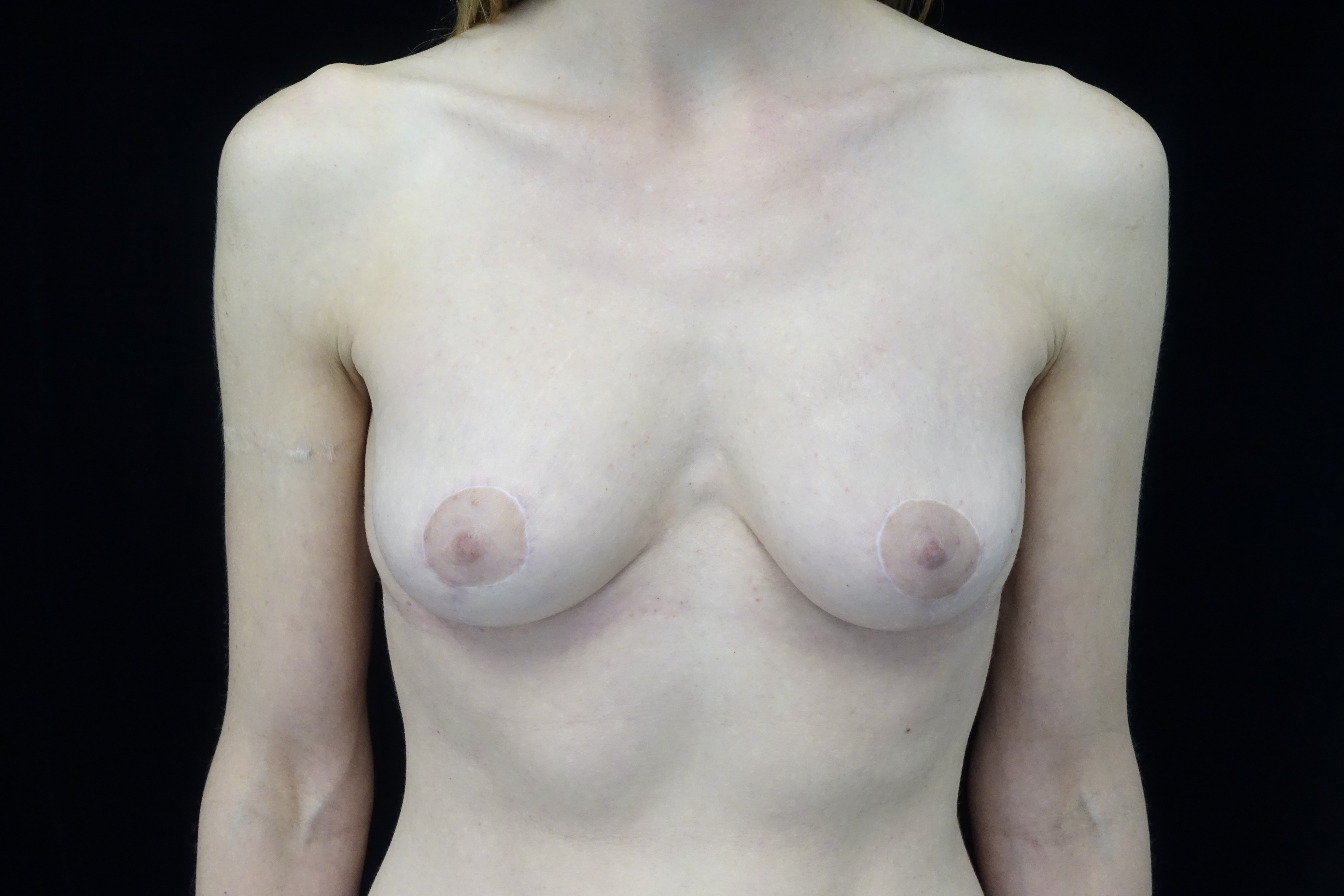 Breast Lift Before & After Patient #14396
