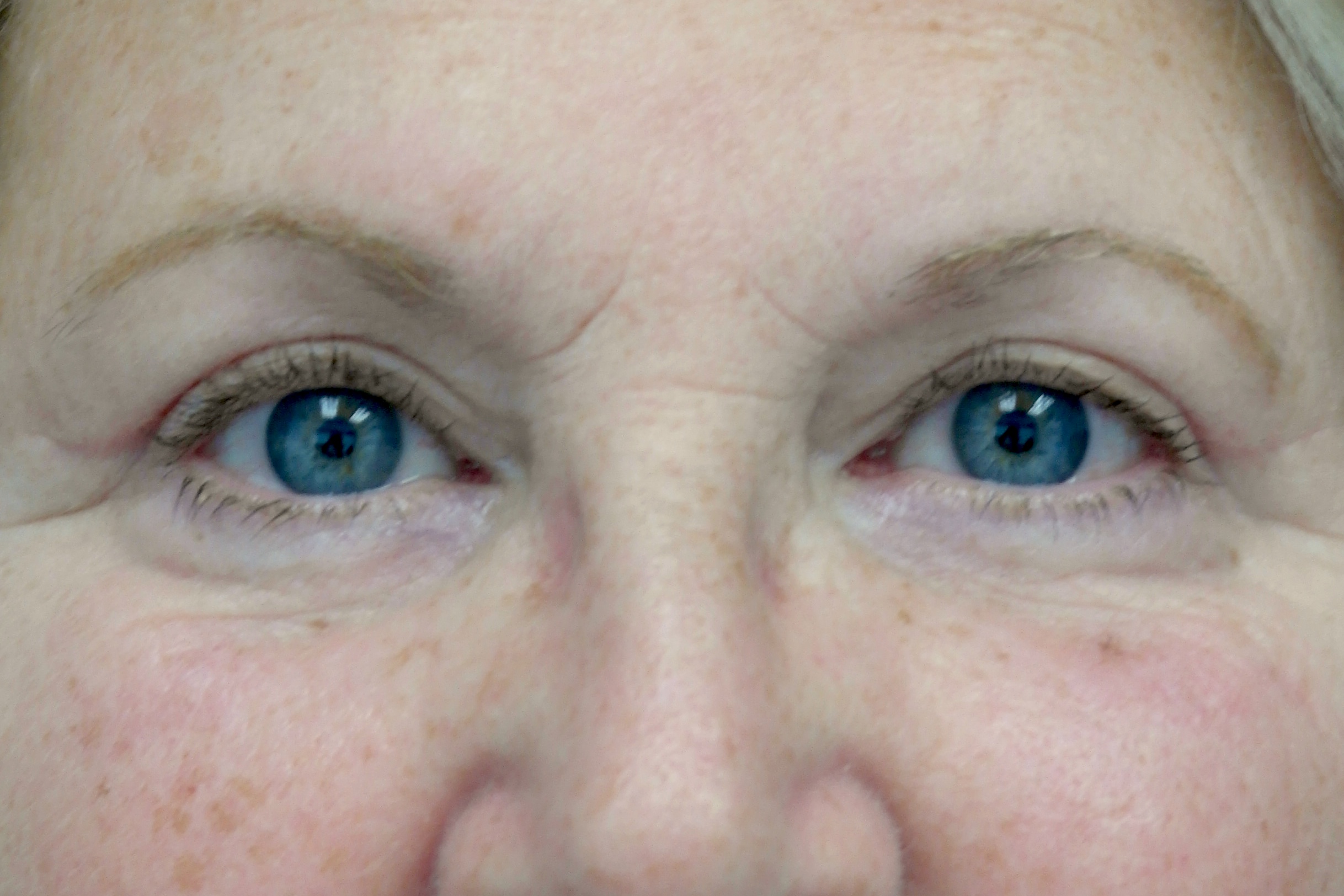 Blepharoplasty Before & After Patient #13899