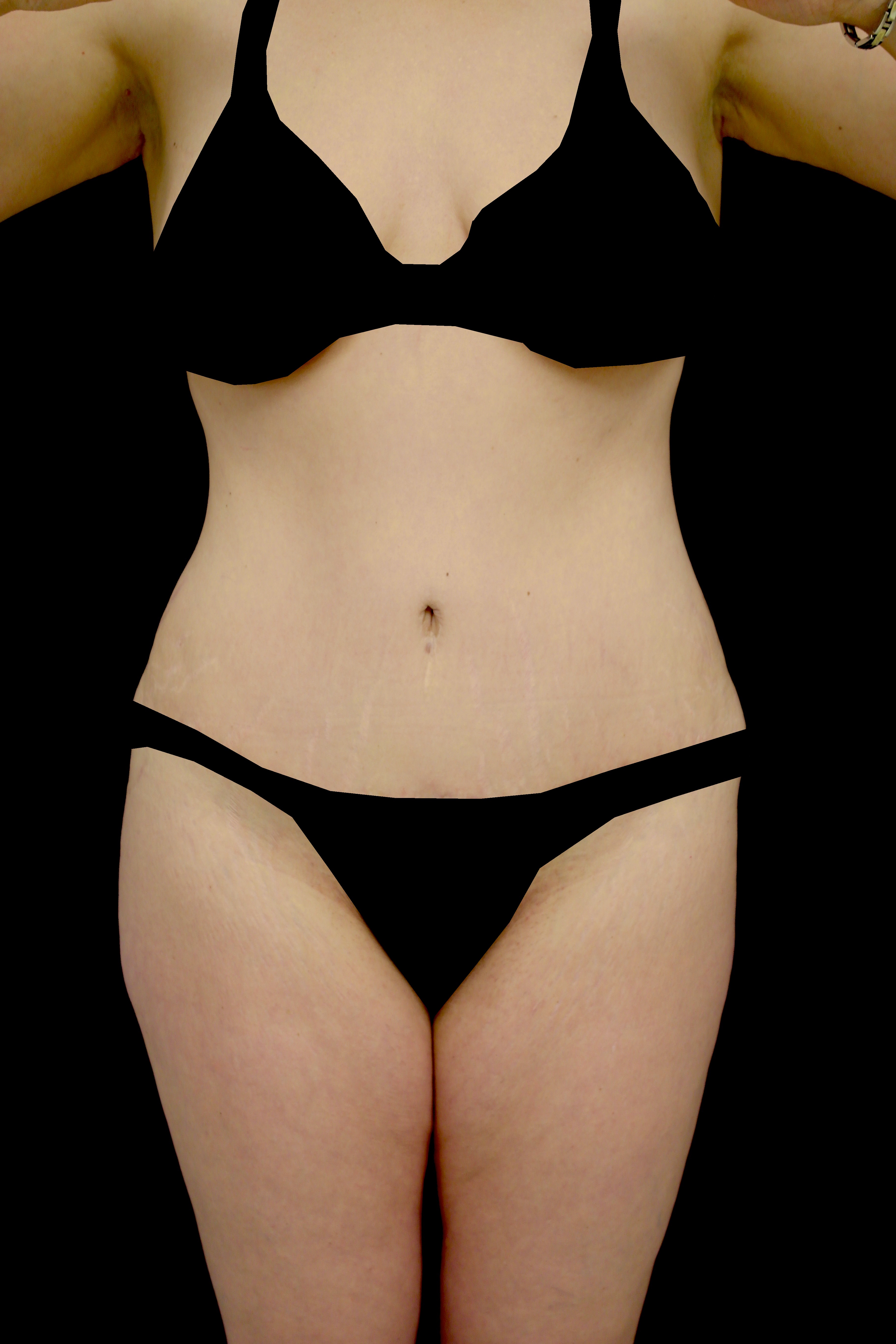 Lipoabdominoplasty Before & After Patient #15061