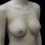 Breast Augmentation (Implants) Before & After Patient #14027