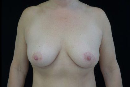 Breast Lift Before & After Patient #14455