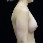 Breast Augmentation (Implants) Before & After Patient #14369