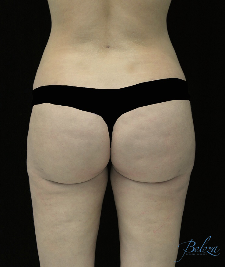 Buttock Augmentation Before & After Patient #14769