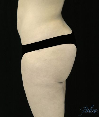 Buttock Augmentation Before & After Patient #14769