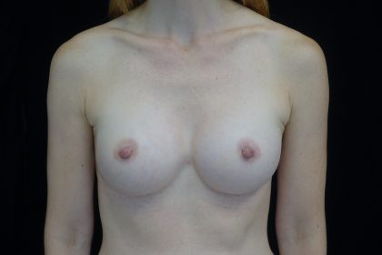 Breast Augmentation (Implants) Before & After Patient #14020
