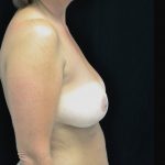 Breast Reduction Before & After Patient #14561