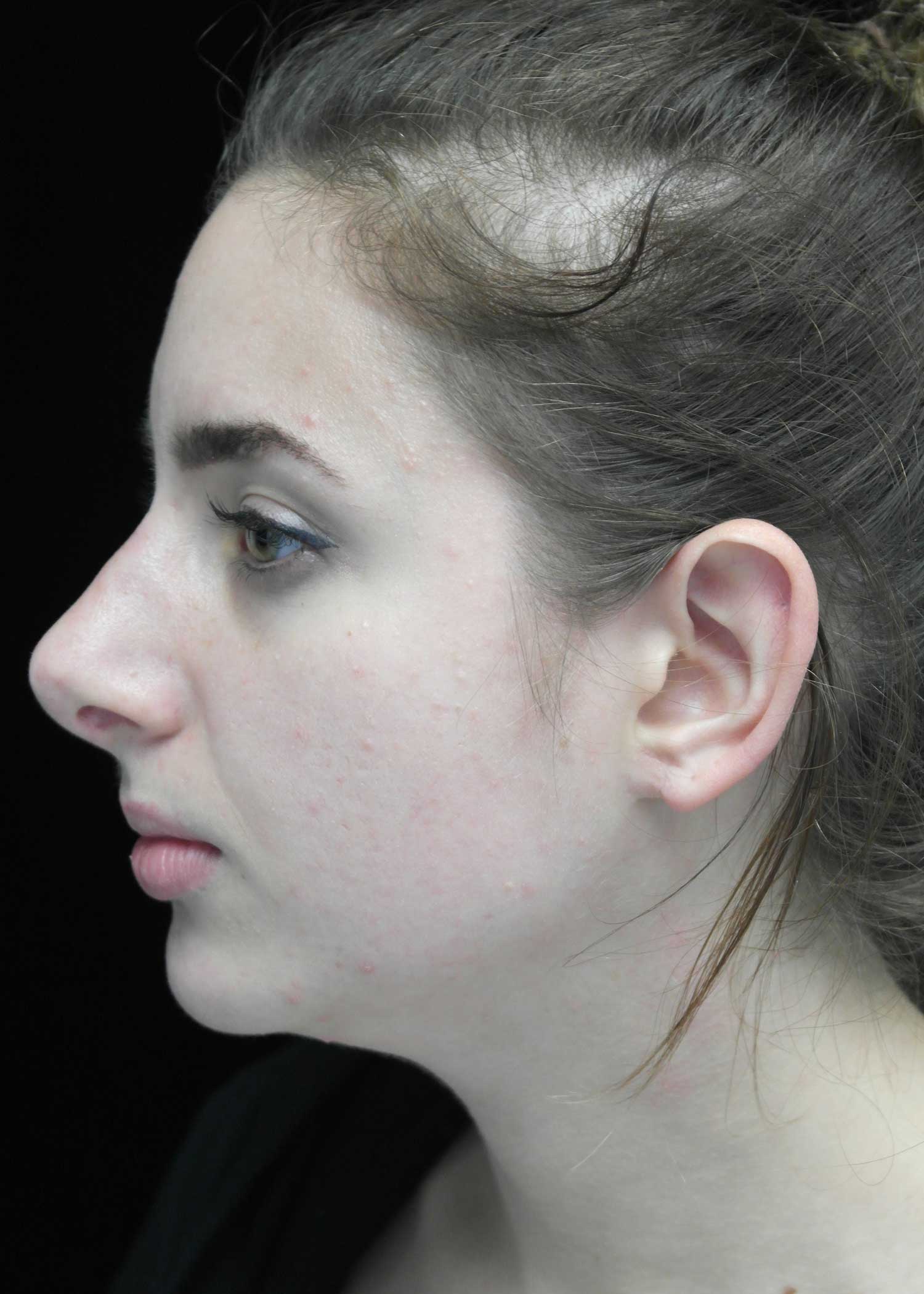 Chin Implants (Augmentation) Before & After Patient #14786