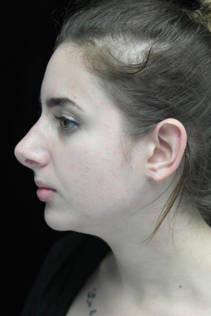 Chin Implants Before & After Patient #14786