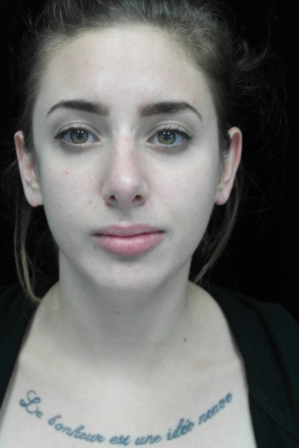 Chin Implants Before & After Patient #14786