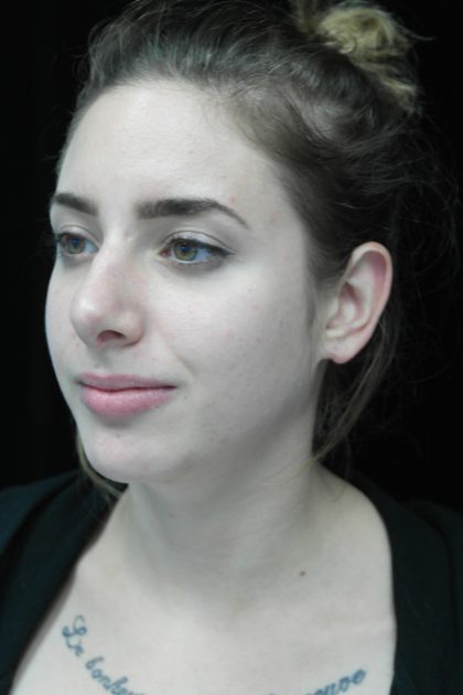Chin Implants Before & After Patient #14786