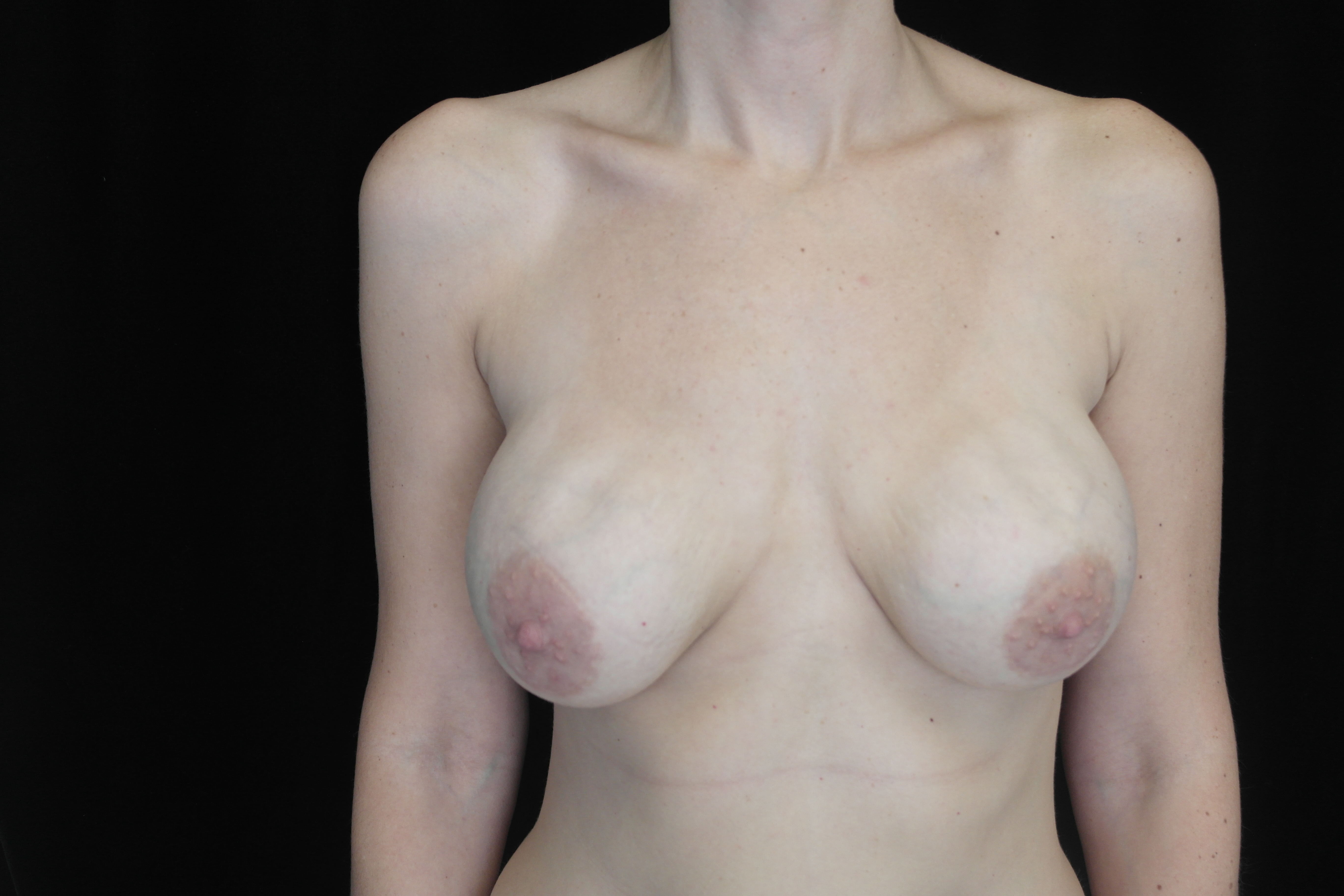 Breast Revision Before & After Patient #14712
