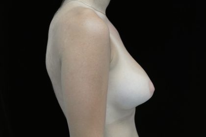 Breast Augmentation (Implants) Before & After Patient #14302