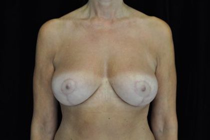 Breast Lift Before & After Patient #14467
