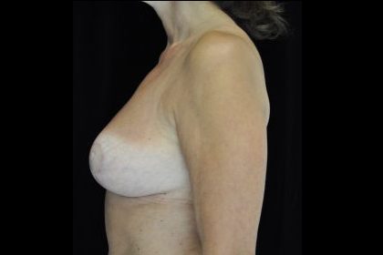 Breast Lift Before & After Patient #14467