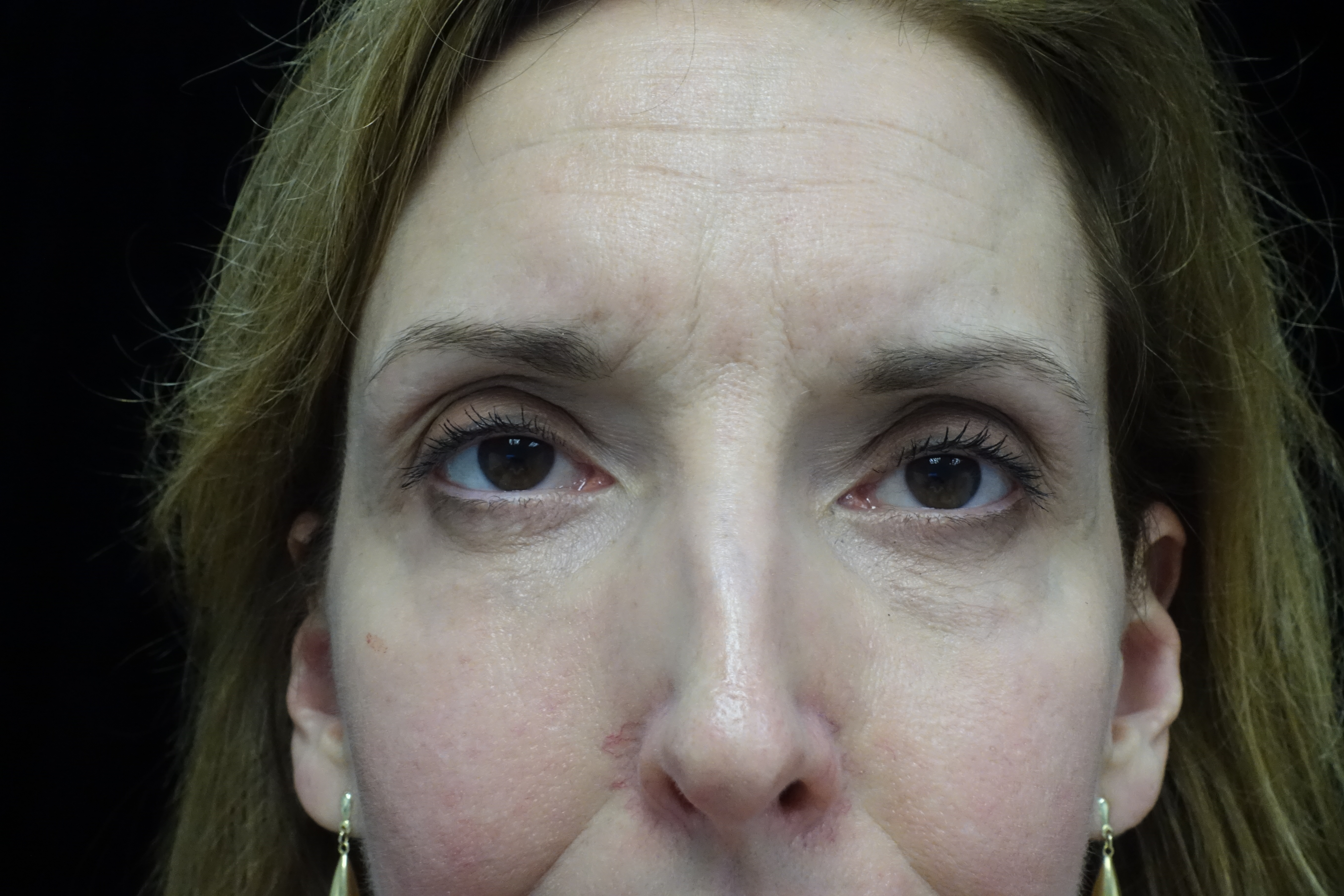 Blepharoplasty Before & After Patient #13908