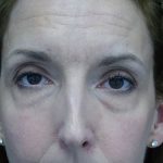 Blepharoplasty Before & After Patient #13908