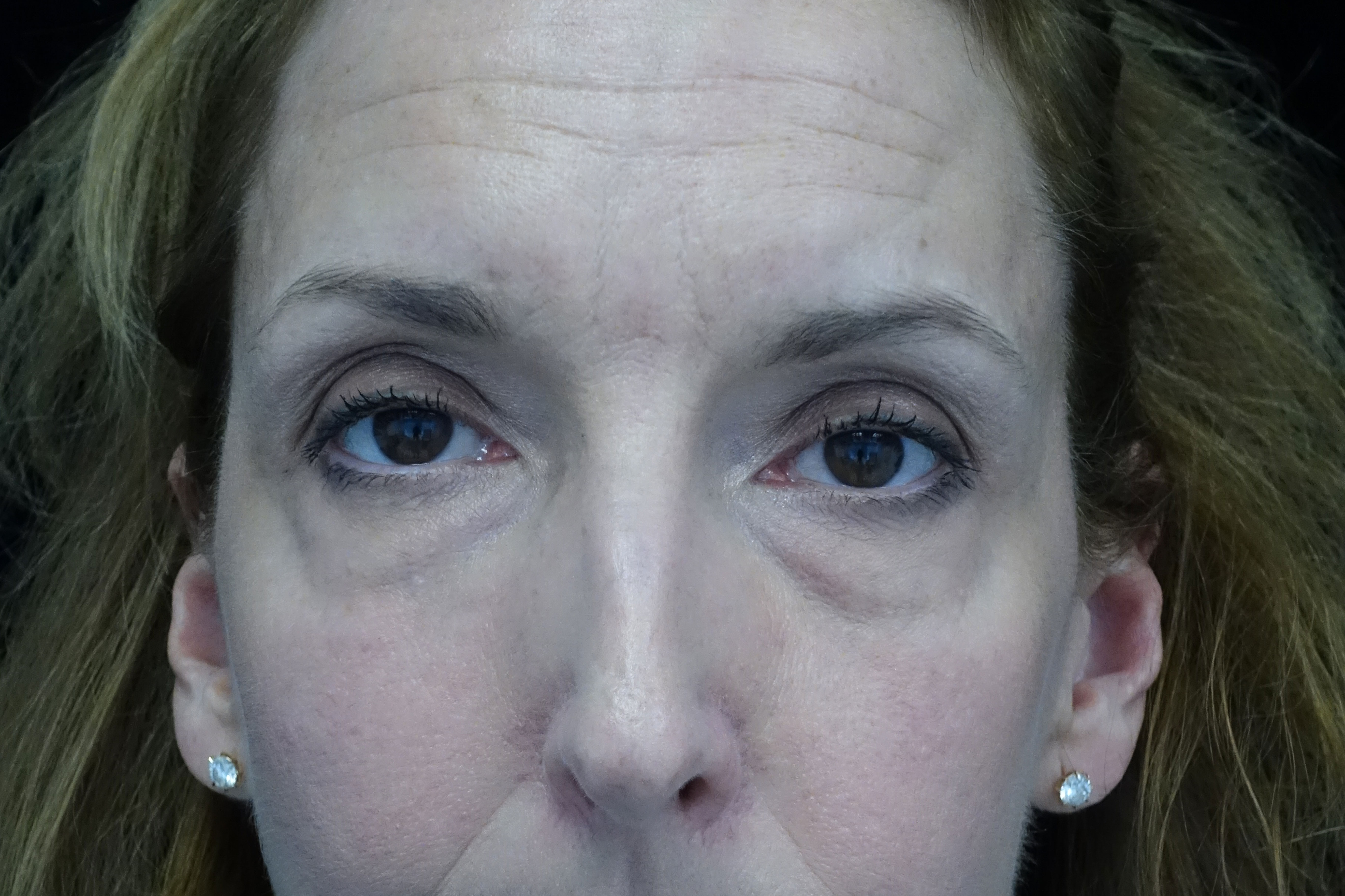 Blepharoplasty Before & After Patient #13908