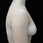 Breast Reduction Before & After Patient #14554