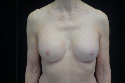 Breast Revision Before & After Patient #14719
