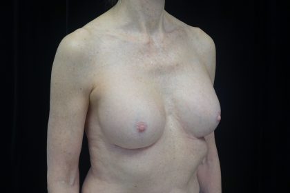 Breast Revision Before & After Patient #14719
