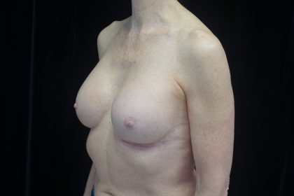 Breast Revision Before & After Patient #14719