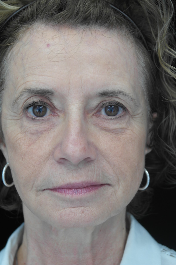 Fat Transfer to Face Before & After Patient #14937