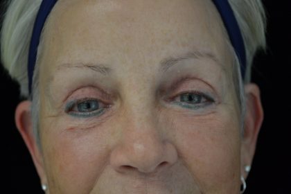 Permanent Cosmetics Before & After Patient #14752