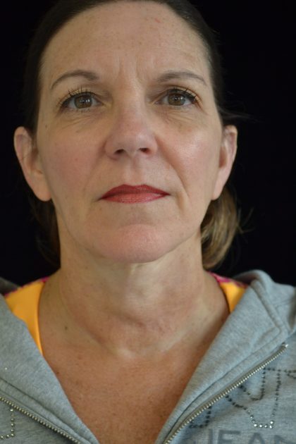 Facelift Before & After Patient #14876