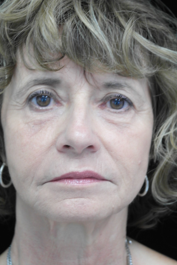 Fat Transfer to Face Before & After Patient #14937