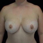 Breast Lift with Implants Before & After Patient #14492