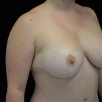 Breast Lift with Implants Before & After Patient #14492