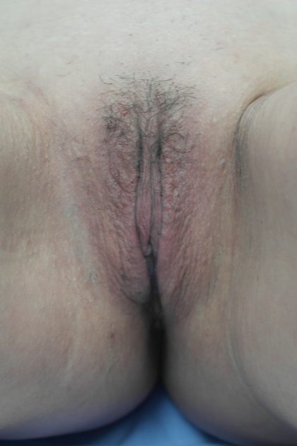 Labiaplasty Before & After Patient #15040